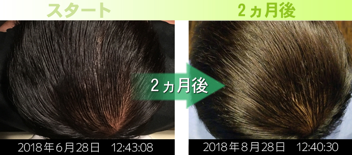 30代男性頭頂部のＡＧＡ治療実績