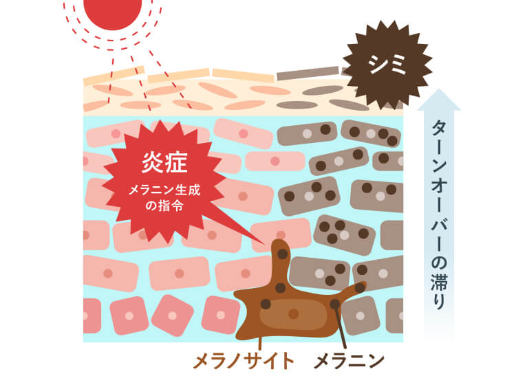 ターンオーバーの乱れにより肌が炎症する図