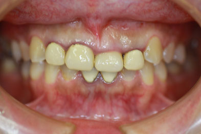 歯茎の整形