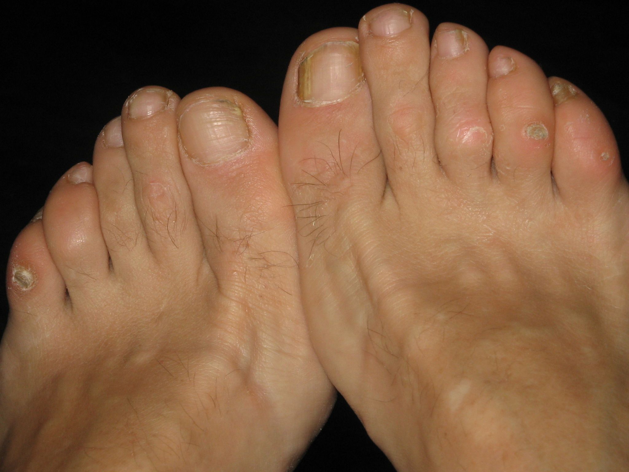 Hammertoe