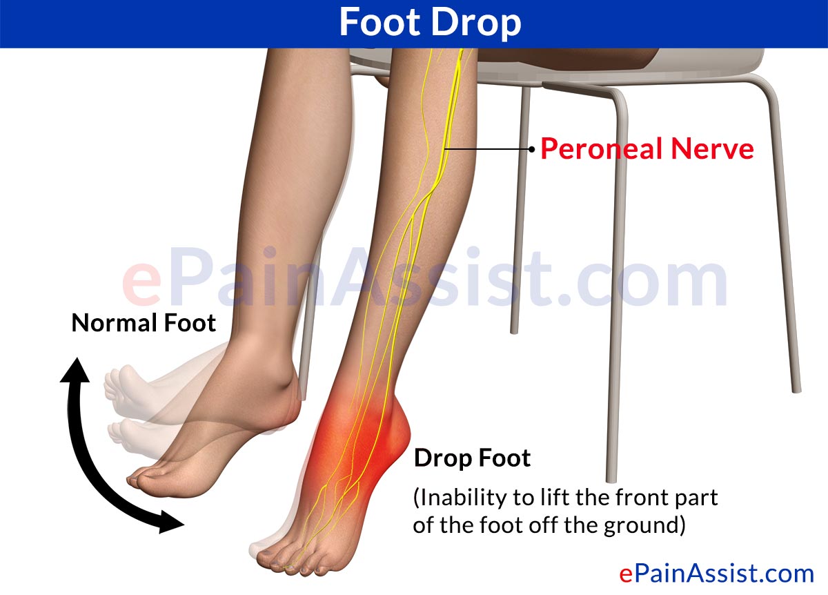 Hammertoe