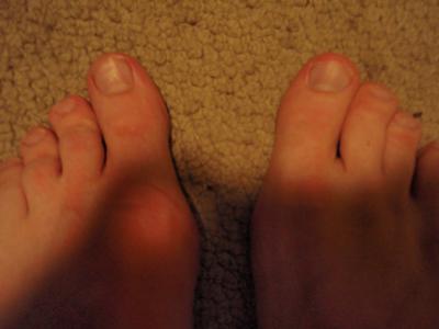 Bunions Hard Skin