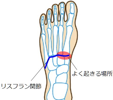 リスフラン関節 足の甲の痛み Fukumoto Sinkyuseikotsuiのブログ
