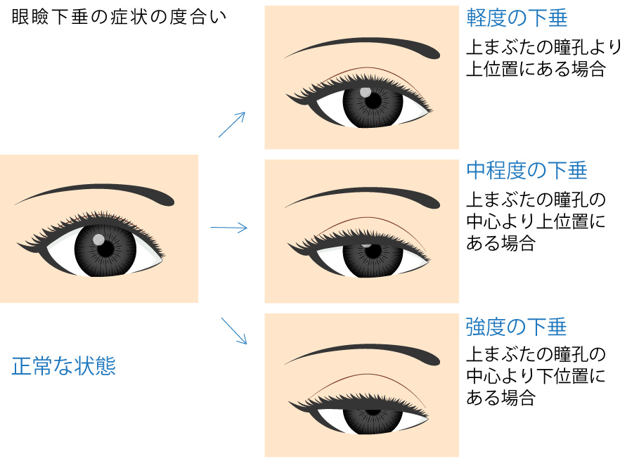 眼瞼下垂