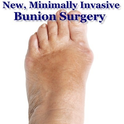 Bunions Callous