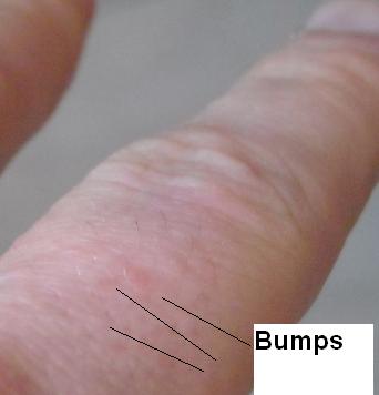 What are the small clear blister like.