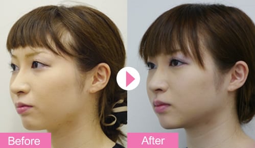 お肌にハリ感を うるおいコラーゲンリフトについて 湘南美容外科クリニック名古屋栄院のブログ