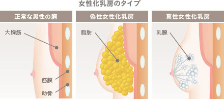 男性なのに胸が膨らんできてお悩みの方 女性化乳房 The Clinic 形成外科専門医 Dr 加藤オフィシャルブログ