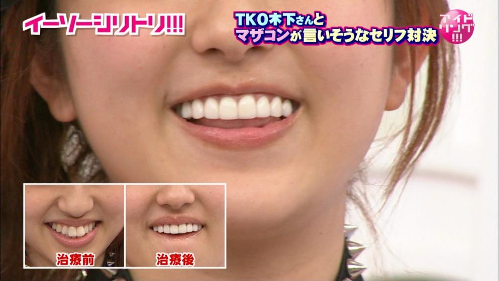 【画像】芸能人は歯が命っ！菊地亜美が出っ歯を治した結果wwwwwwww ごんた兄貴のブログ