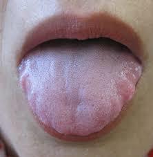 舌 に 歯形 が つく 原因