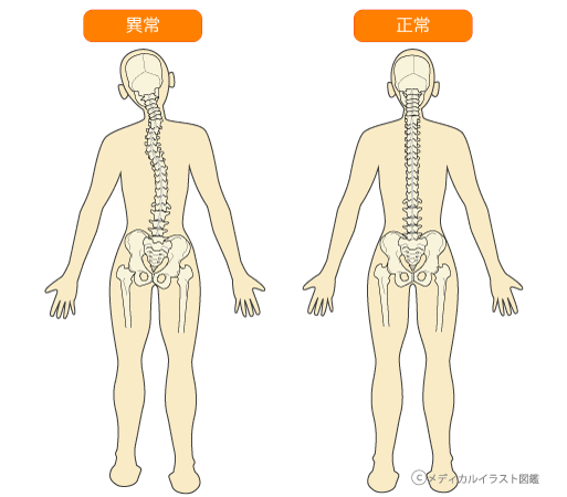 セール 登場から人気沸騰 大塚整体 脊柱 側湾症 木型 健康/医学 - www